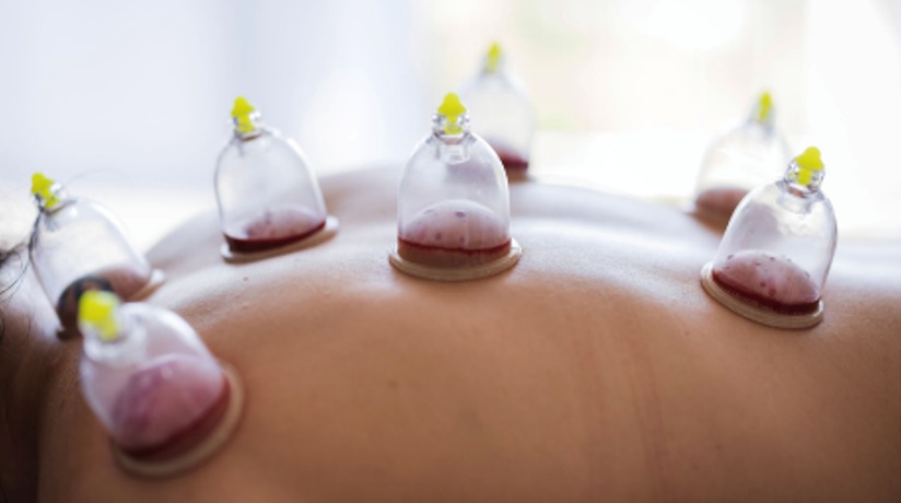Mobile cupping therapy with cups applied to back in Lancashire